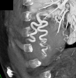 Dilated Coronary Artery in An Er Patient - CTisus CT Scan