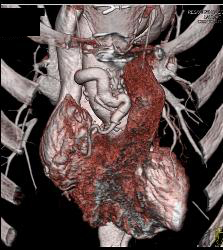 Reimplanted Right Coronary Artery - CTisus CT Scan