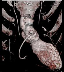 Aneurysm of Reimplanted RCA - CTisus CT Scan