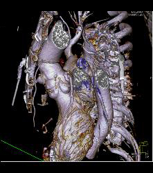 Post Aortic Root Repair With Reimplantation of Coronary Arteries and Aneurysm of Origin of RCA - CTisus CT Scan