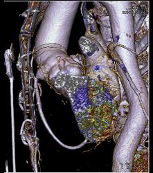 Post Aortic Root Repair With Reimplantation of Coronary Arteries and Aneurysm of Origin of RCA - CTisus CT Scan