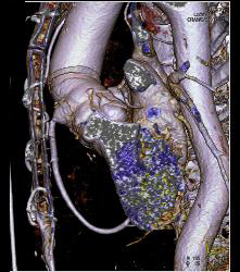 Post Aortic Root Repair With Reimplantation of Coronary Arteries and Aneurysm of Origin of RCA - CTisus CT Scan