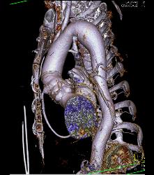 Post Aortic Root Repair With Reimplantation of Coronary Arteries and Aneurysm of Origin of RCA - CTisus CT Scan