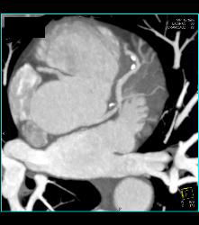 CCTA: Left Anterior Descending Coronary Artery (LAD) Plaque Without Critical Stenosis - CTisus CT Scan