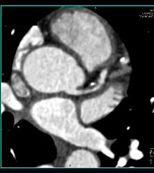 CCTA: Mixed Plaque Left Anterior Descending Coronary Artery (LAD) With Greater Than 50% Stenosis- See Multiple Perspectives - CTisus CT Scan