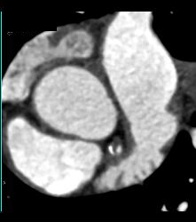 CCTA: Mixed Plaque Left Anterior Descending Coronary Artery (LAD) With Greater Than 50% Stenosis- See Multiple Perspectives - CTisus CT Scan