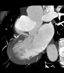 CCTA: Mixed Plaque Left Anterior Descending Coronary Artery (LAD) With Greater Than 50% Stenosis- See Multiple Perspectives - CTisus CT Scan