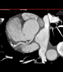 CCTA: Mixed Plaque Left Anterior Descending Coronary Artery (LAD) With Greater Than 50% Stenosis- See Multiple Perspectives - CTisus CT Scan