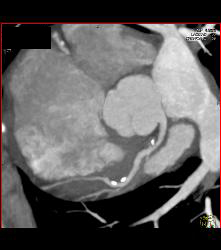 CCTA: Mixed Plaque Left Anterior Descending Coronary Artery (LAD) With Greater Than 50% Stenosis- See Multiple Perspectives - CTisus CT Scan