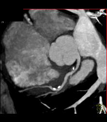 CCTA: Mixed Plaque Left Anterior Descending Coronary Artery (LAD) With Greater Than 50% Stenosis- See Multiple Perspectives - CTisus CT Scan