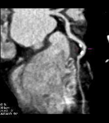 CCTA: Mixed Plaque Left Anterior Descending Coronary Artery (LAD) With Greater Than 50% Stenosis- See Multiple Perspectives - CTisus CT Scan