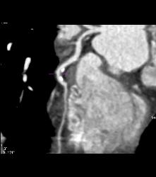 CCTA: Mixed Plaque Left Anterior Descending Coronary Artery (LAD) With Greater Than 50% Stenosis- See Multiple Perspectives - CTisus CT Scan