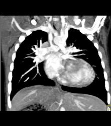 Patent B-t Shunt - CTisus CT Scan