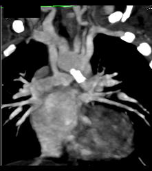 Patent B-t Shunt - CTisus CT Scan