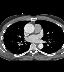 Dilated Aortic Root - CTisus CT Scan