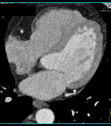 Increased Fat in Right Ventricular Wall - CTisus CT Scan