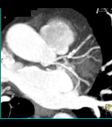 Left Anterior Descending Coronary Artery (LAD) Plaque - CTisus CT Scan