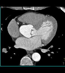 Left Anterior Descending Coronary Artery (LAD) Plaque - CTisus CT Scan