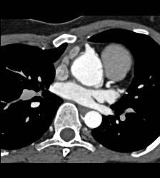 Dilated RCA After Reimplantation S/p Root Repair - CTisus CT Scan