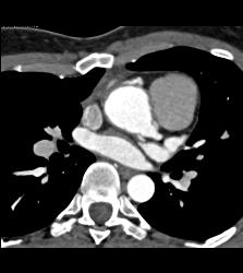 Dilated RCA After Reimplantation S/p Root Repair - CTisus CT Scan