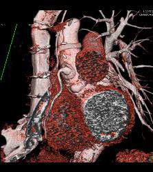 Dilated RCA After Reimplantation S/p Root Repair - CTisus CT Scan