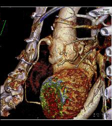 Dilated RCA After Reimplantation S/p Root Repair - CTisus CT Scan