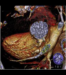 Dilated RCA After Reimplantation S/p Root Repair - CTisus CT Scan