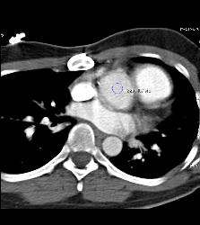 CT Chart for Bolus Triggering Technique - CTisus CT Scan