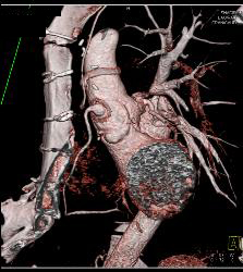 Dilated RCA After Reimplantation S/p Root Repair - CTisus CT Scan