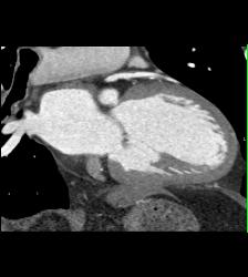 CCTA: Left Anterior Descending Coronary Artery (LAD) Plaque Without Critical Stenosis - CTisus CT Scan