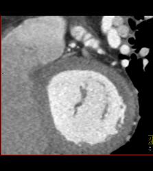 CCTA: Left Anterior Descending Coronary Artery (LAD) Plaque Without Critical Stenosis - CTisus CT Scan