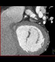 CCTA: Left Anterior Descending Coronary Artery (LAD) Plaque Without Critical Stenosis - CTisus CT Scan