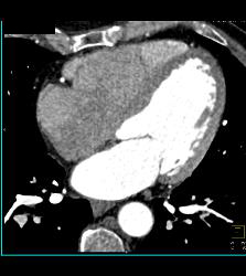 CCTA: Left Anterior Descending Coronary Artery (LAD) Plaque Without Critical Stenosis - CTisus CT Scan