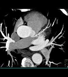 CCTA: Left Anterior Descending Coronary Artery (LAD) Plaque Without Critical Stenosis - CTisus CT Scan