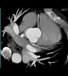 CCTA: Left Anterior Descending Coronary Artery (LAD) Plaque Without Critical Stenosis - CTisus CT Scan