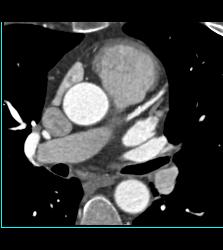 CCTA: Left Anterior Descending Coronary Artery (LAD) Plaque Without Critical Stenosis - CTisus CT Scan