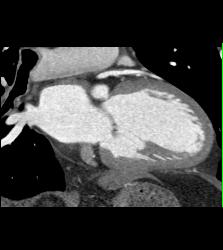 CCTA: Left Anterior Descending Coronary Artery (LAD) Plaque Without Critical Stenosis - CTisus CT Scan