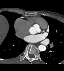 Bicuspid Valve - CTisus CT Scan