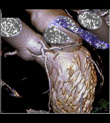 CCTA: Left Anterior Descending Coronary Artery (LAD) Mixed Plaque - CTisus CT Scan