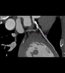 CCTA: Left Anterior Descending Coronary Artery (LAD) Mixed Plaque - CTisus CT Scan