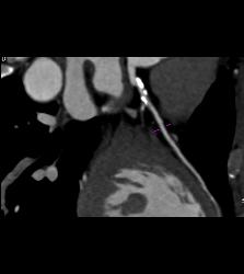 CCTA: Left Anterior Descending Coronary Artery (LAD) Mixed Plaque - CTisus CT Scan