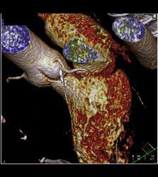 CCTA: Left Anterior Descending Coronary Artery (LAD) Mixed Plaque - CTisus CT Scan