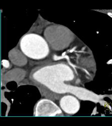 CCTA: Left Anterior Descending Coronary Artery (LAD) Mixed Plaque - CTisus CT Scan