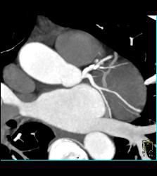 CCTA: Left Anterior Descending Coronary Artery (LAD) Mixed Plaque - CTisus CT Scan