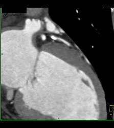 CCTA: Left Anterior Descending Coronary Artery (LAD) Mixed Plaque - CTisus CT Scan