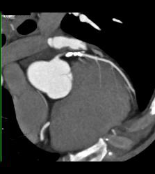 CCTA: Left Anterior Descending Coronary Artery (LAD) Mixed Plaque - CTisus CT Scan