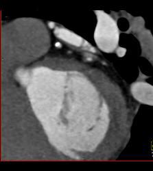 CCTA: Left Anterior Descending Coronary Artery (LAD) Mixed Plaque - CTisus CT Scan