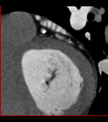 CCTA: Left Anterior Descending Coronary Artery (LAD) Mixed Plaque - CTisus CT Scan