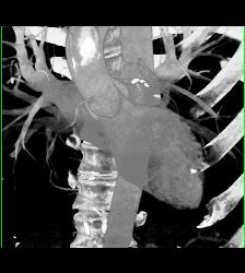 CCTA: Left Anterior Descending Coronary Artery (LAD) Mixed Plaque - CTisus CT Scan