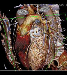 Normal VRT of Coronary Arteries and MIP as Well - CTisus CT Scan